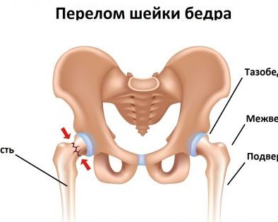 Перелом шейки бедра: как распознать, чем лечить и как долго придётся восстанавливаться